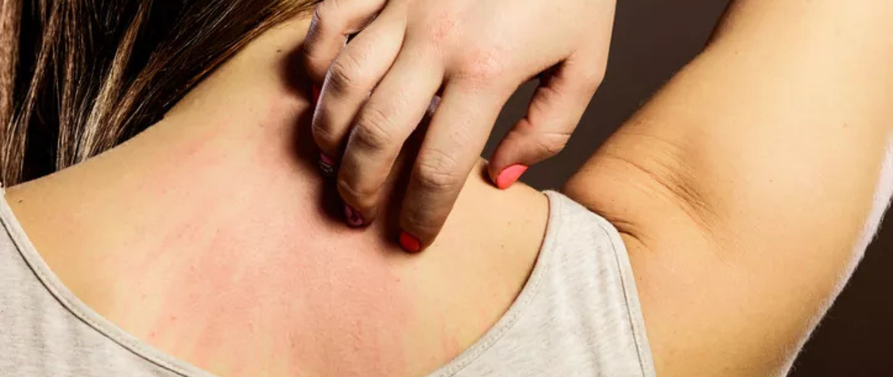 Hölgy nyakánál ruha okozta allergiás folt.